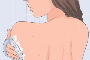 Why do acne appear on the back?